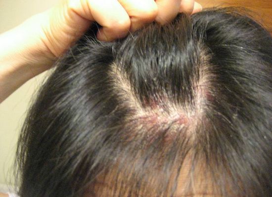 Would Any Stage of Scalp Psoriasis Cause Hair Loss? - MyRujukan