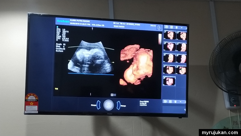 Paparan scan 5D dan detailed scan pada monitor ultrasound